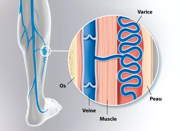 Varices sympt mes et traitement des jambes lourdes